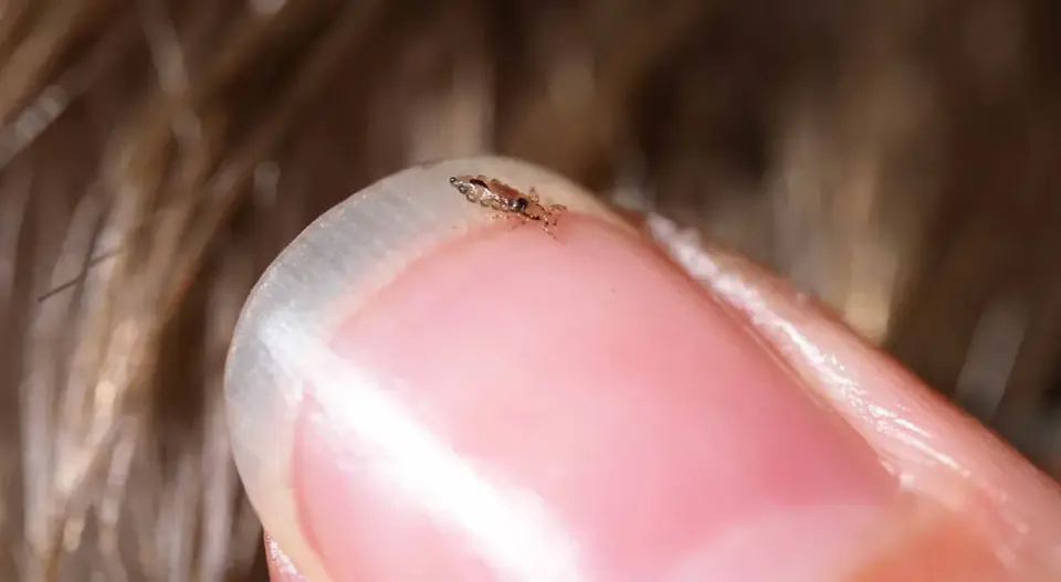 Pidocchi nei bambini - come riconoscerli e trattarli senza panico